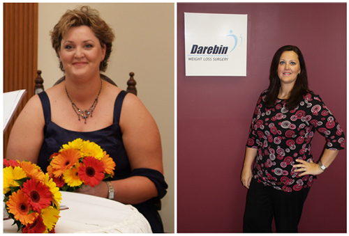 kelly-gastric-sleeve-before-after kelly-gastric-sleeve-before-after