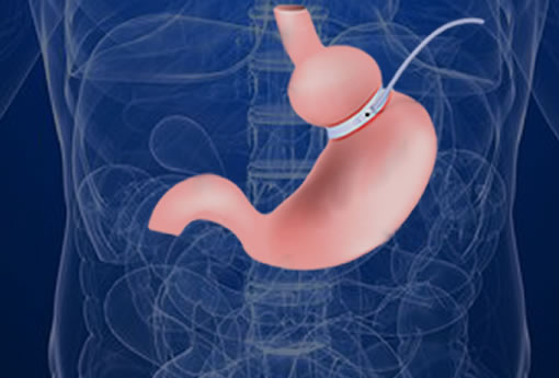Darebin-weight-loss-surgery-gastric-bandx510 Darebin-weight-loss-surgery-gastric-band