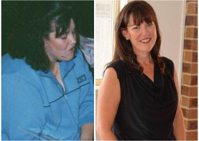 Kylie’s Gastric Bypass