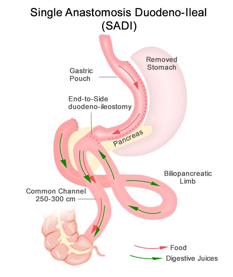 SADI Single Anastomosis Duodenal-Ileal Bypass with Sleeve Gastrectomy (SADI-S)
